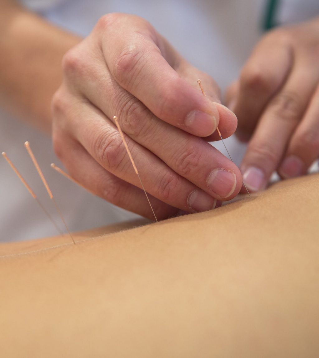 acupuncture for pain